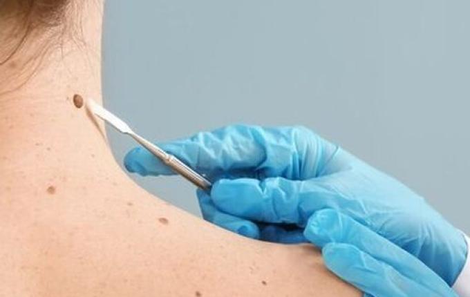 SC é o estado que mais registra casos de melanoma no Brasil