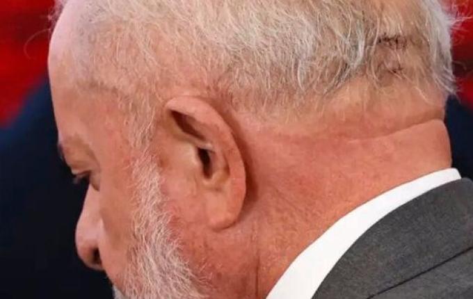 Médico atualiza estado de saúde de Lula após segunda cirurgia