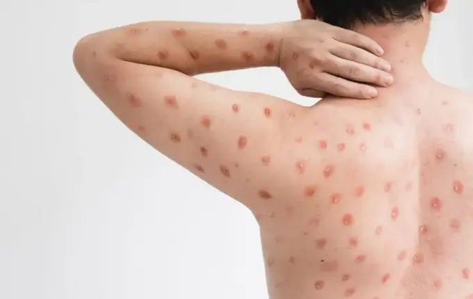 Santa Catarina monitora 16 casos suspeitos de mpox em 2026